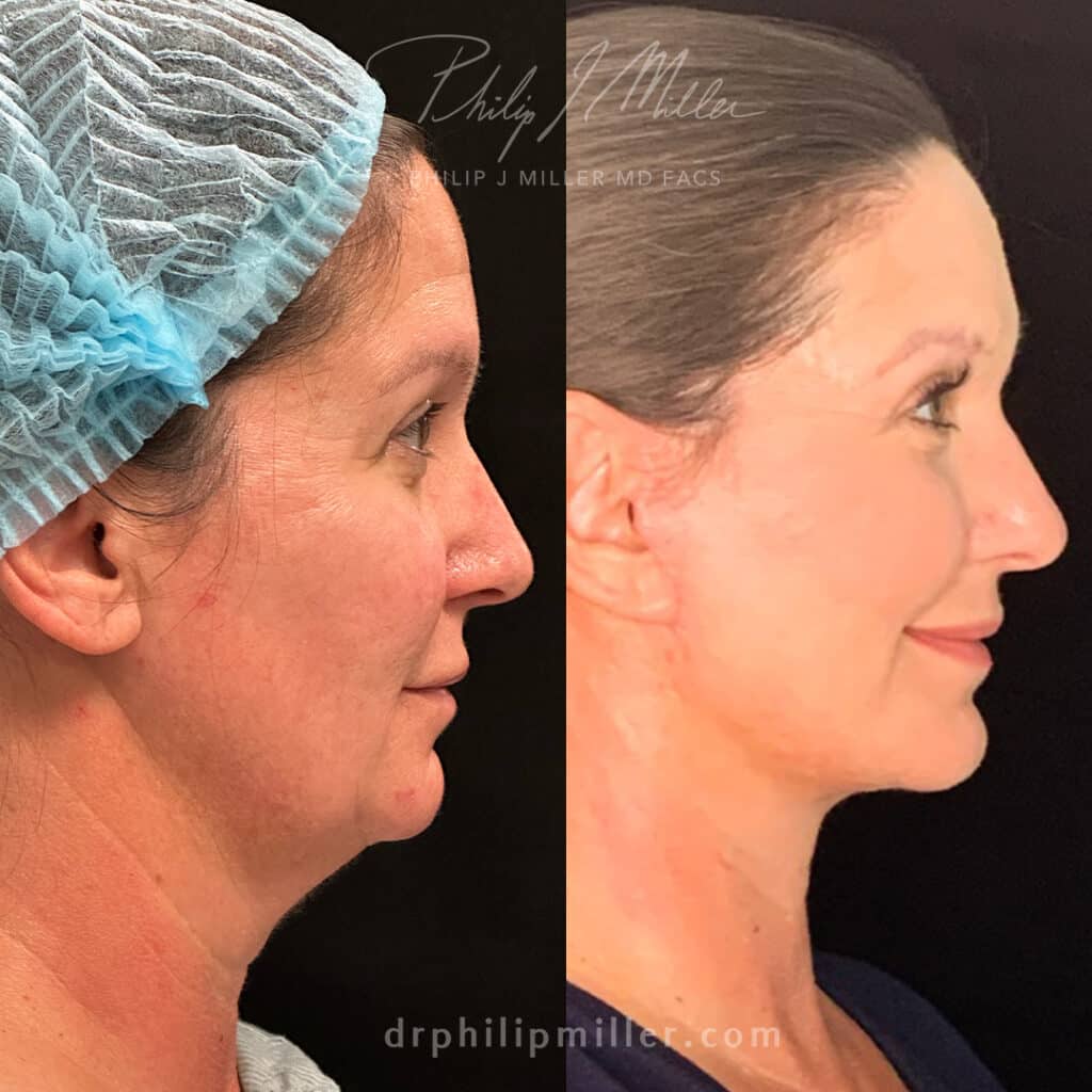 Combined facelift and neck lift to lift and tighten the skin around the face and neck, unveiling a rejuvenated and naturally youthful appearance by Dr. Miller.