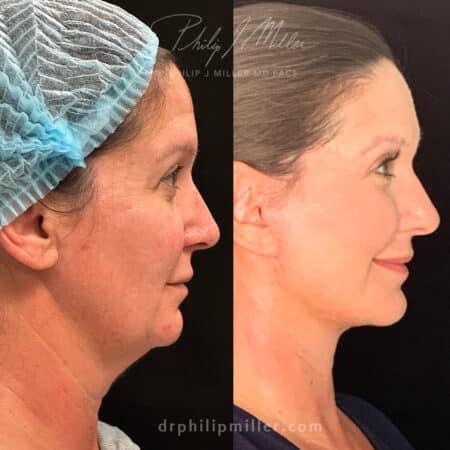 Facelift and Neck Lift to Take Years Off Patient’s Appearance Before and After