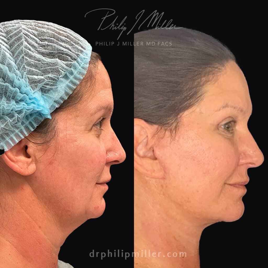 Combined facelift and neck lift to lift and tighten the skin around the face and neck, unveiling a rejuvenated and naturally youthful appearance by Dr. Miller.