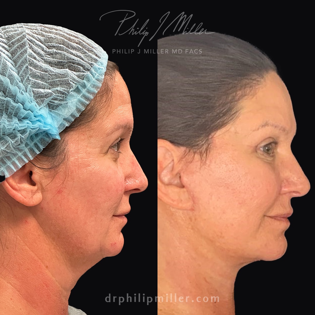 Neck Lift in New York City - Philip Miller MD