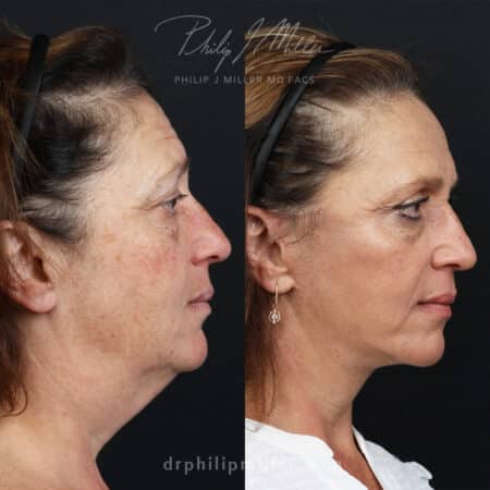 Facelift to Refine the Lower Face, Jawline, and Neck Before and After