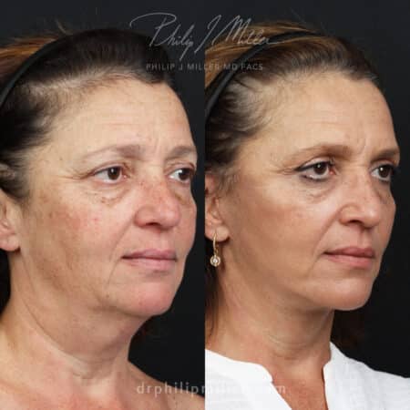 Facelift to Refine the Lower Face, Jawline, and Neck Before and After