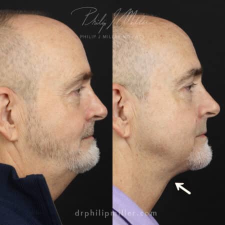 Facelift to Remove and Tighten Excess Skin Around the Lower Face Before and After