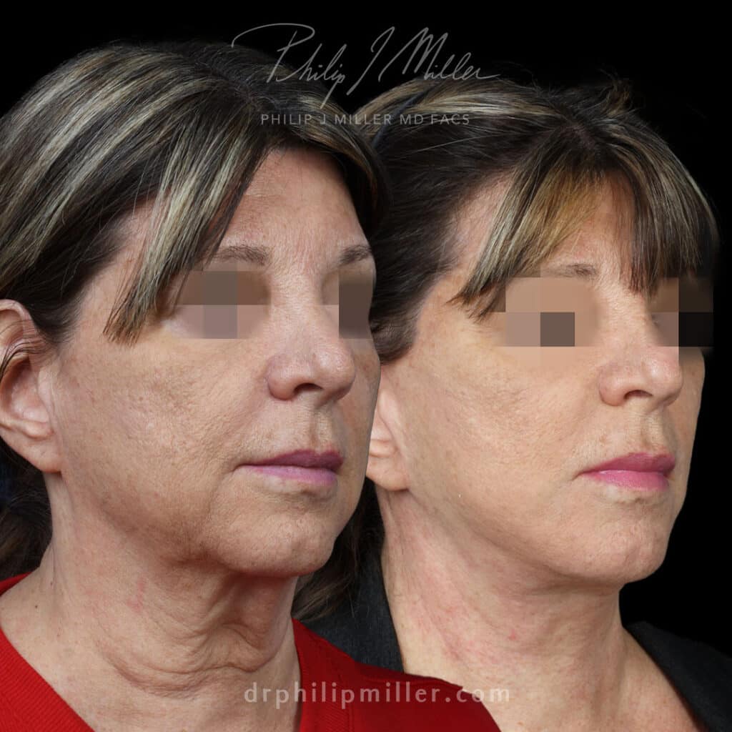 Facelift to refine the jawline and lower face while tightening crepey neck skin.
