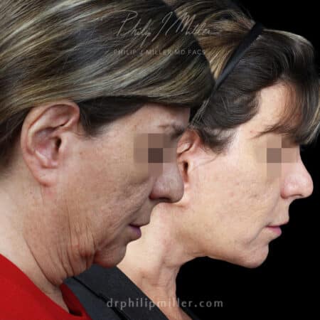 Facelift to Enhance the Lower Face, Jawline, and Neck Area