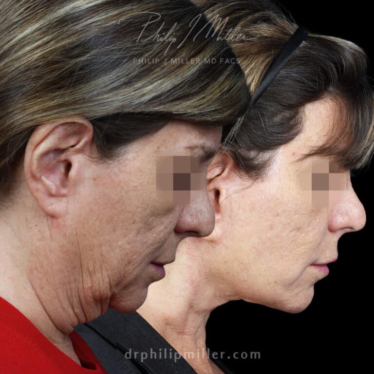 Facelift to refine the jawline and lower face while tightening crepey neck skin by Dr. Miller.