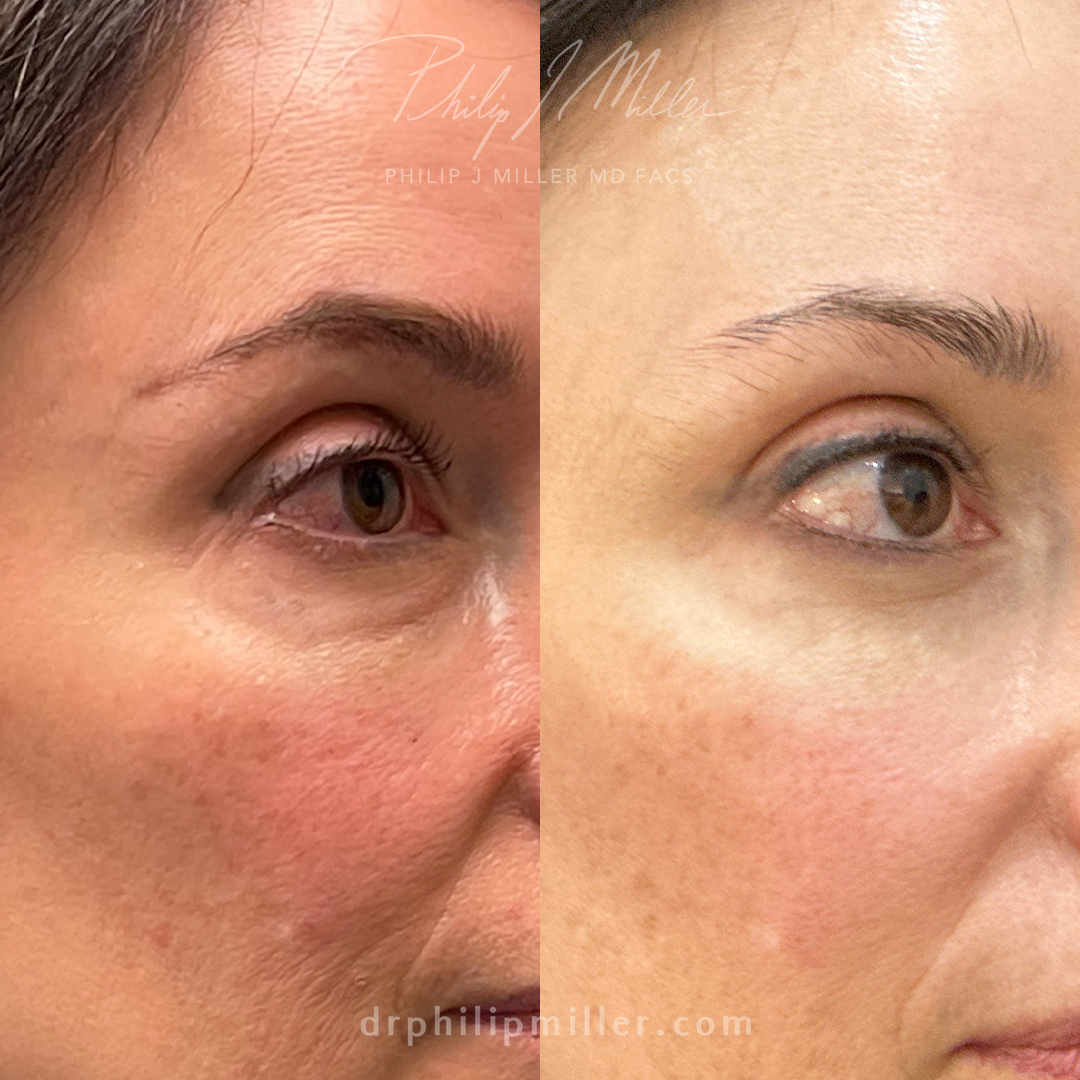 Lower blepharoplasty to smooth and rejuvenate the skin underneath the eyes.