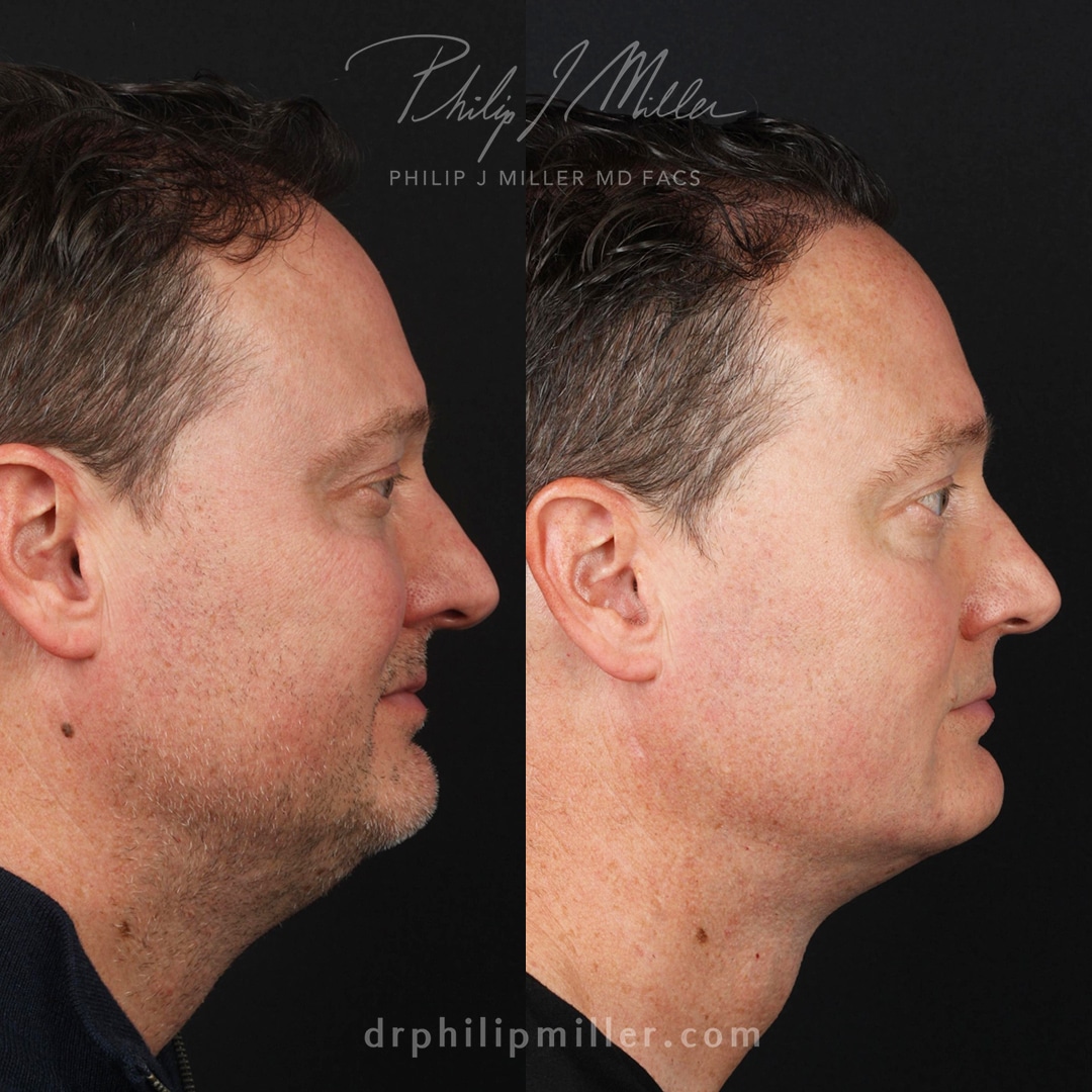 Neck lift to improve the facial profile and slim the jawline by Dr. Miller.