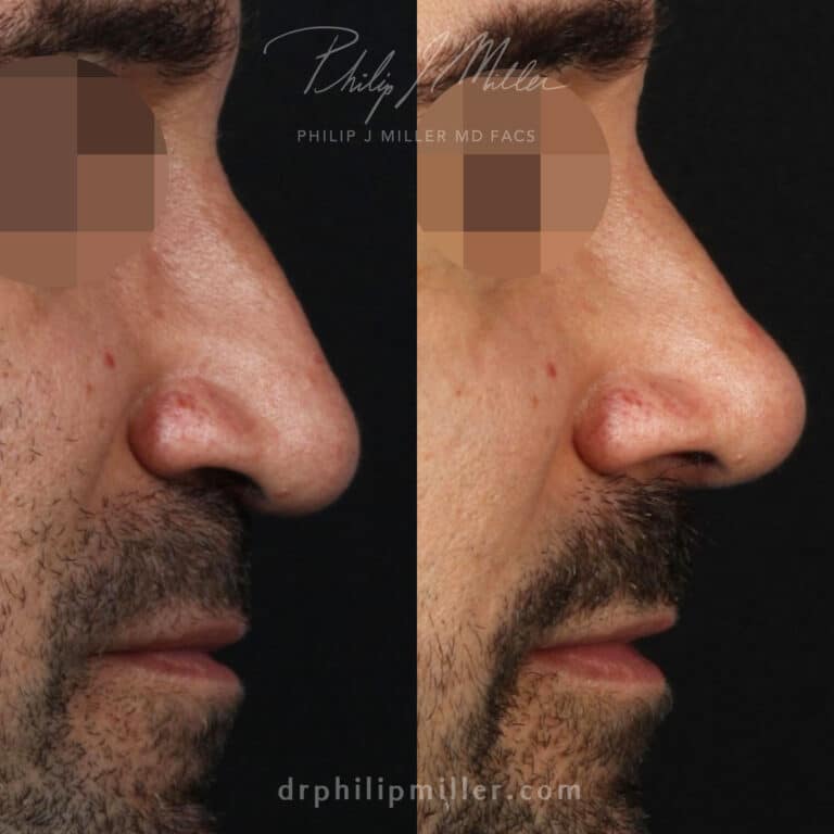 Rhinoplasty to smooth the nasal bridge and lift and refine the nasal tip by Dr. Miller.