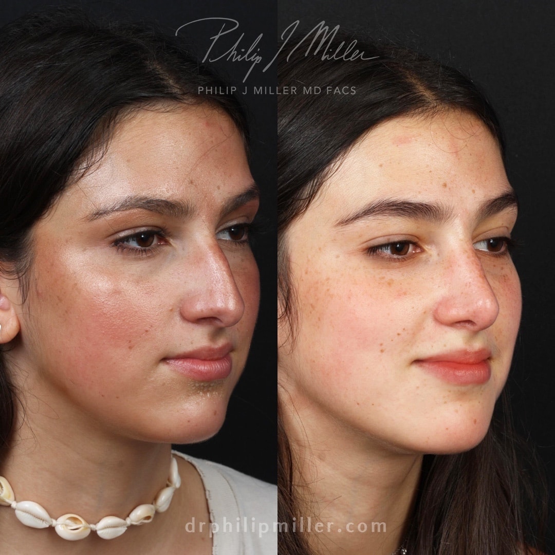 Rhinoplasty to lower and smooth dorsal hump for a smoother, more refined profile by Dr. Miller.