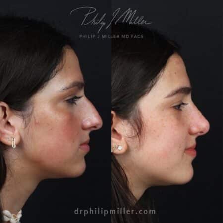 Rhinoplasty to Enhance Patient’s Profile Before and After