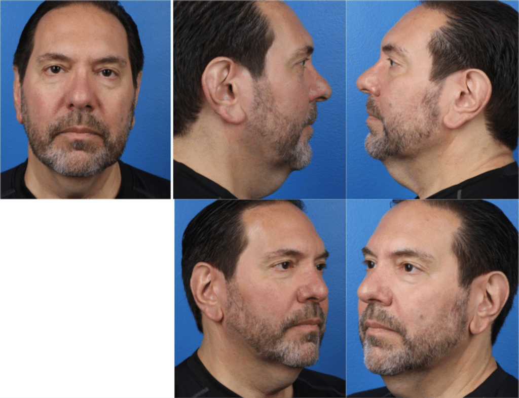 facelift patient before the procedure