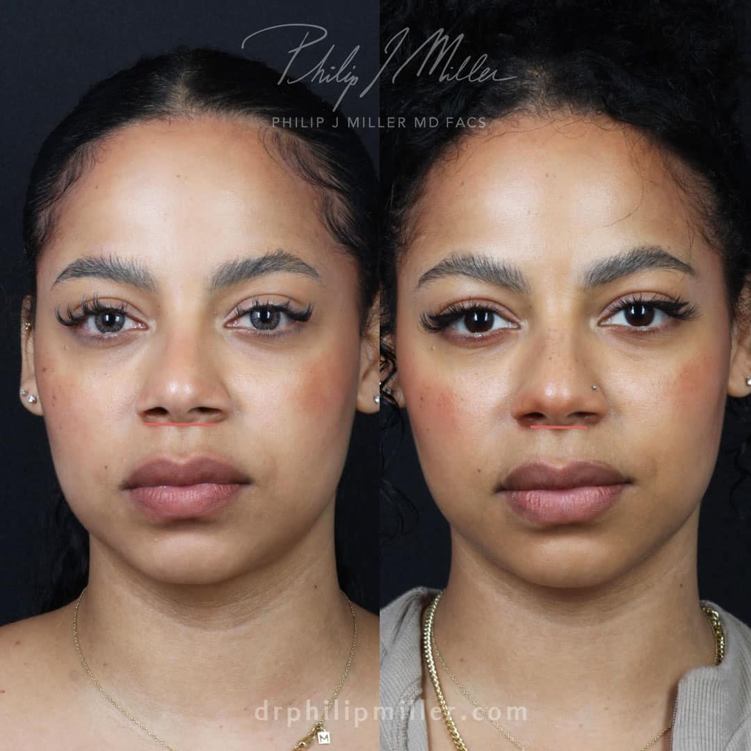 Alar base reduction to enhance facial harmony and balance with the nose by Dr. Miller.