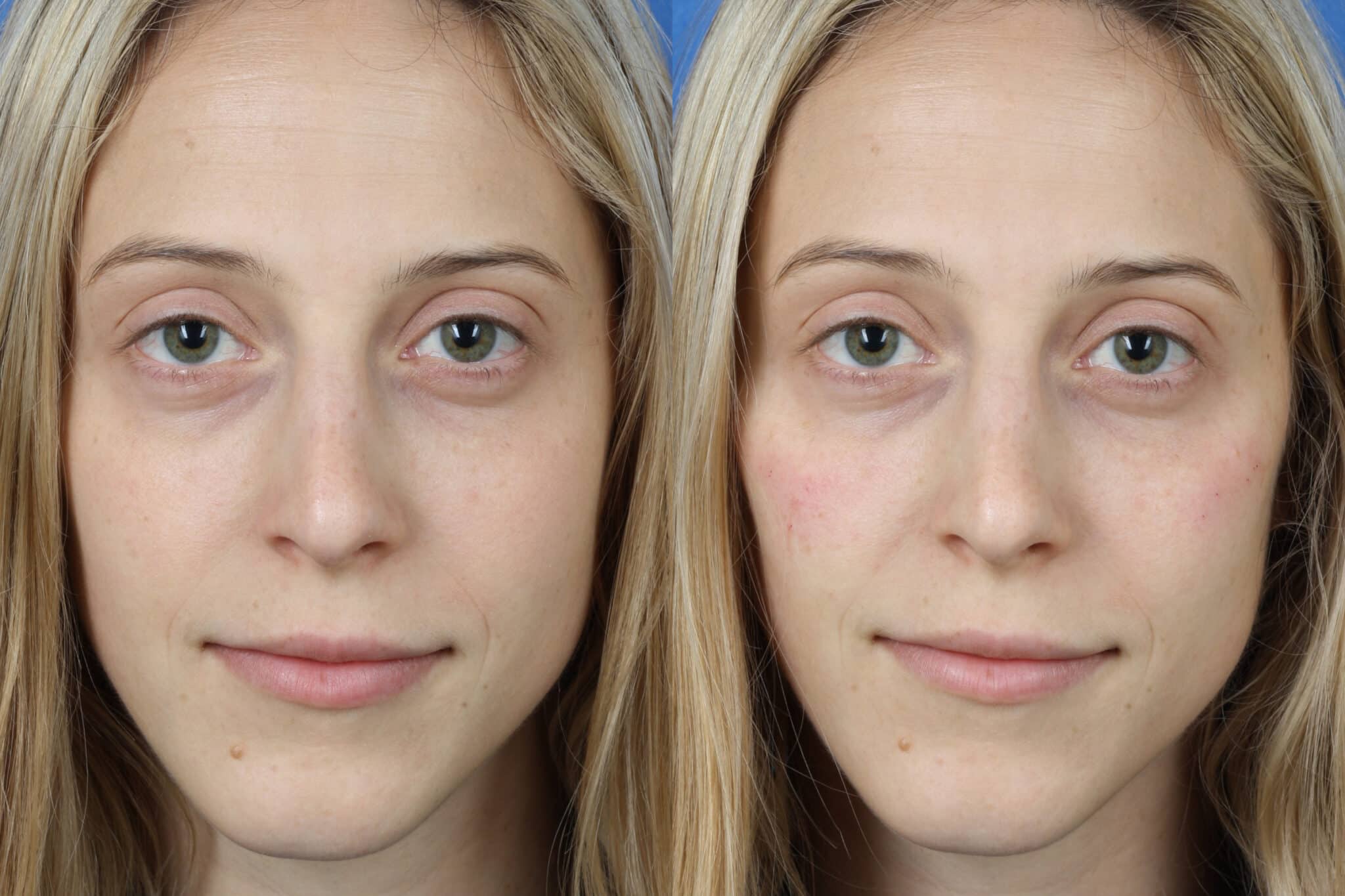 How to Make Your Face Less Flat? 6 Surgical and Non-surgical Options -  Philip Miller MD