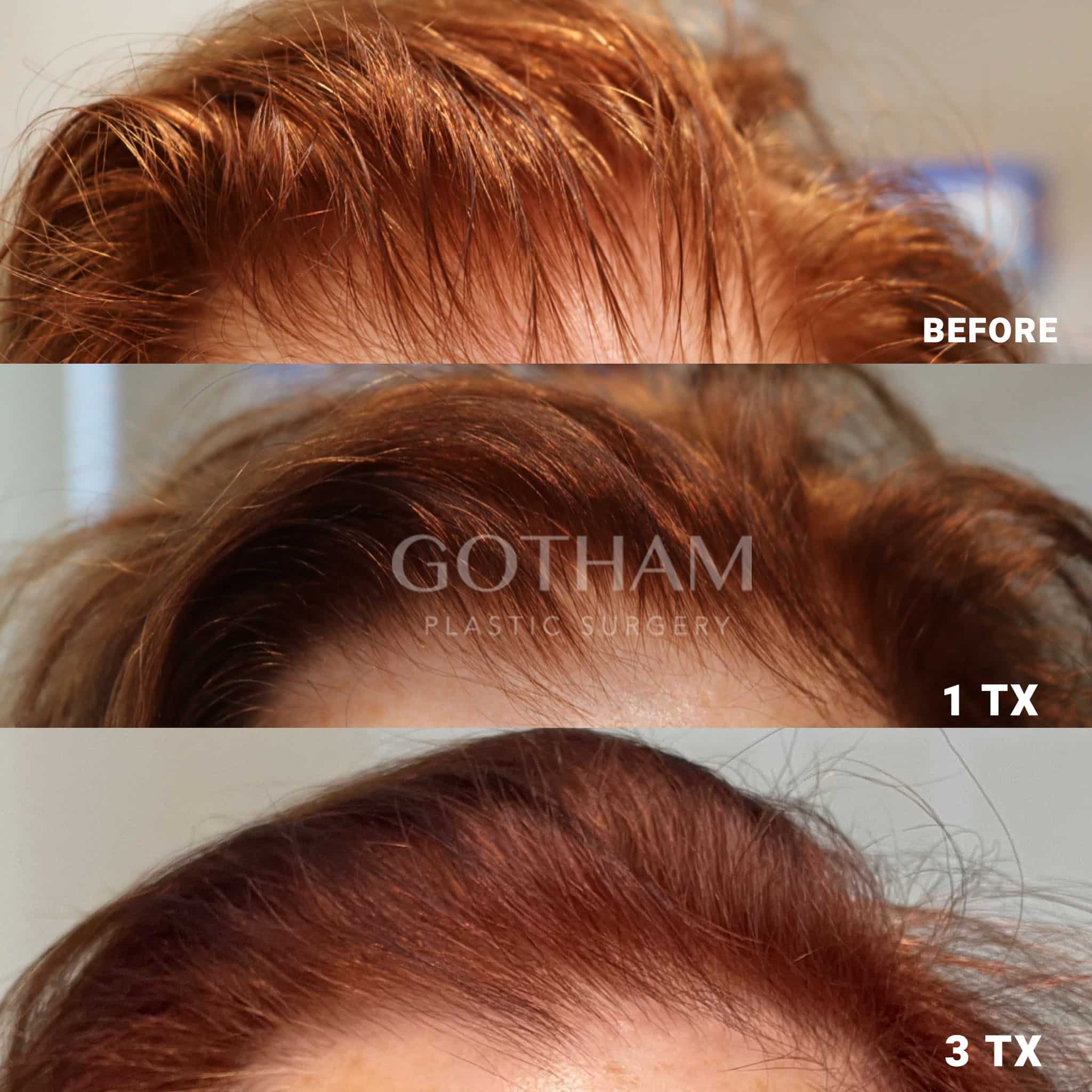 PRF hair restoration to encourage growth and fullness along the hairline and crown by Dr. Miller.