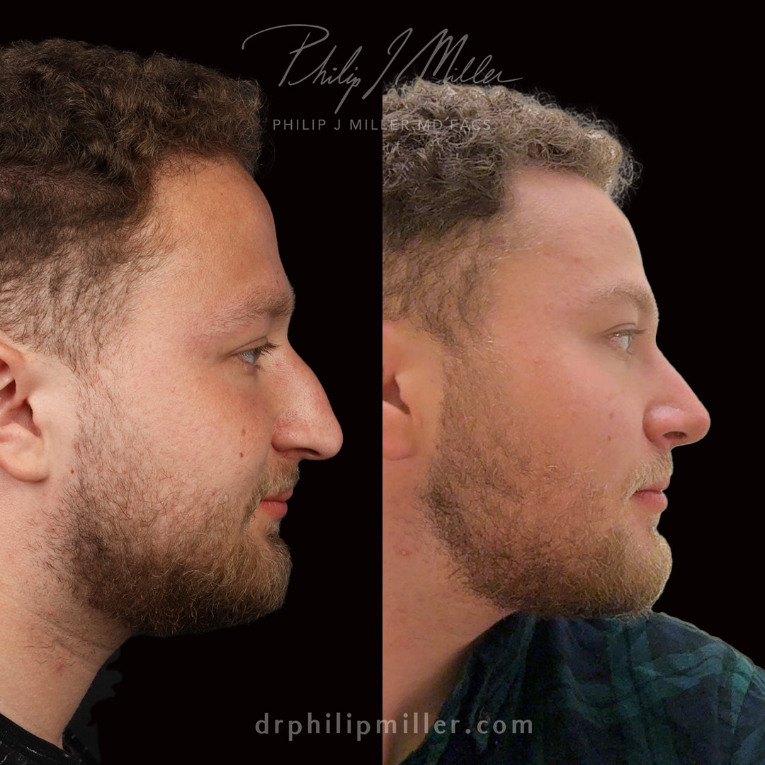 Male patient 3 months post rhinoplasty to remove the dorsal hump and lift the tip by Dr. Miller.
