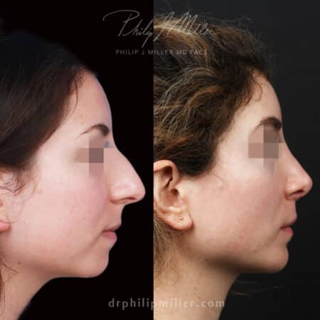 Rhinoplasty Revision to Enhance the Nose’s Profile Before and After