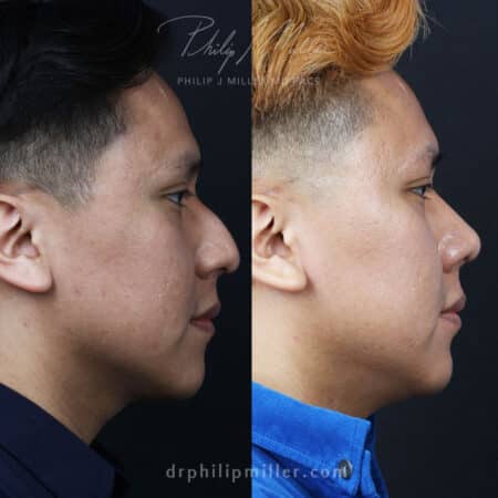 Rhinoplasty to Reshape and Refine the Nose Before and After