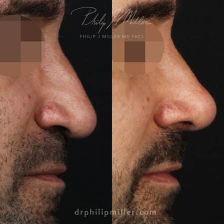 Tip Plasty to Refine the Nasal Tip and Enhance the Facial Profile Before and After