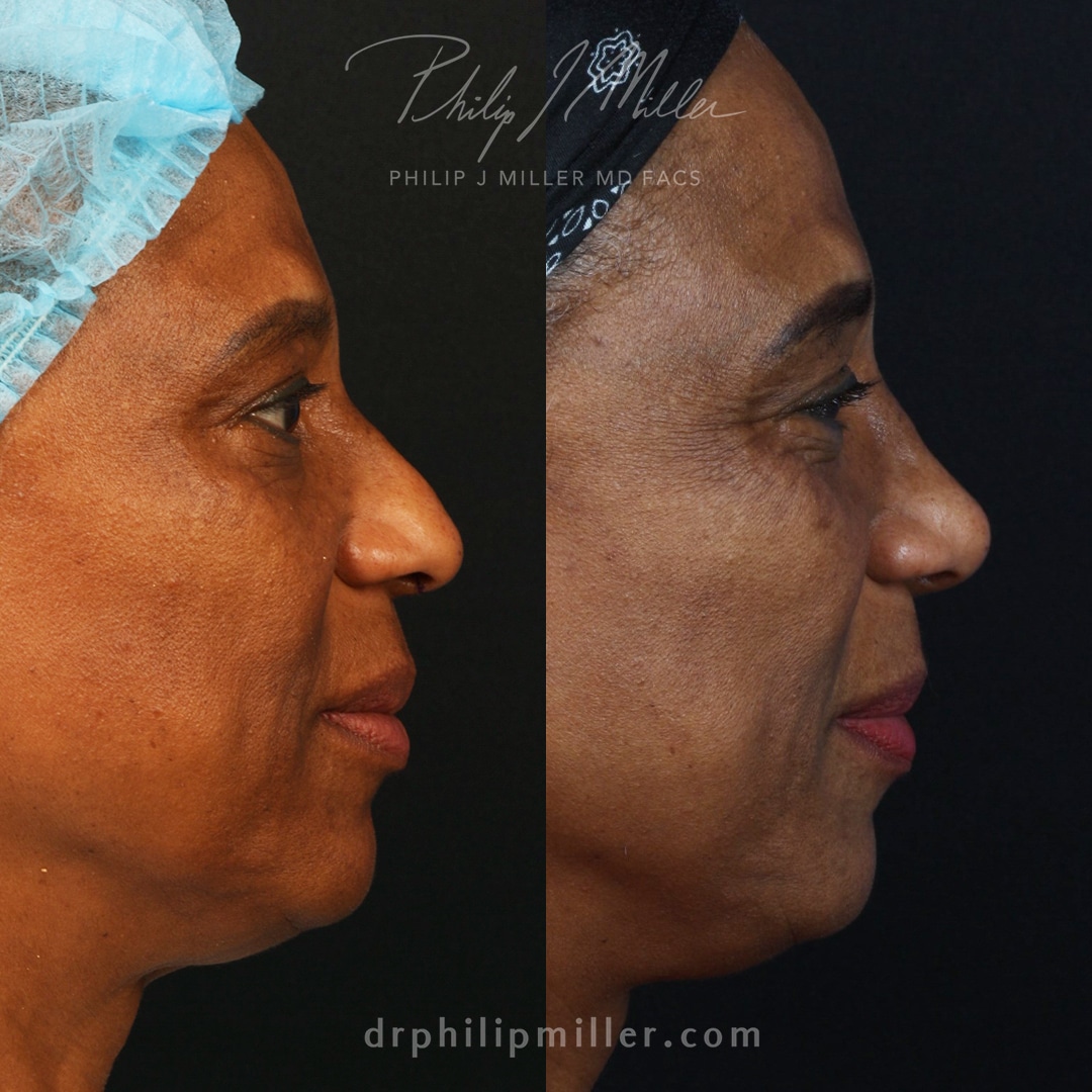 Ethnic rhinoplasty to smooth the nasal bridge and refine the nasal tip by Dr. Miller.