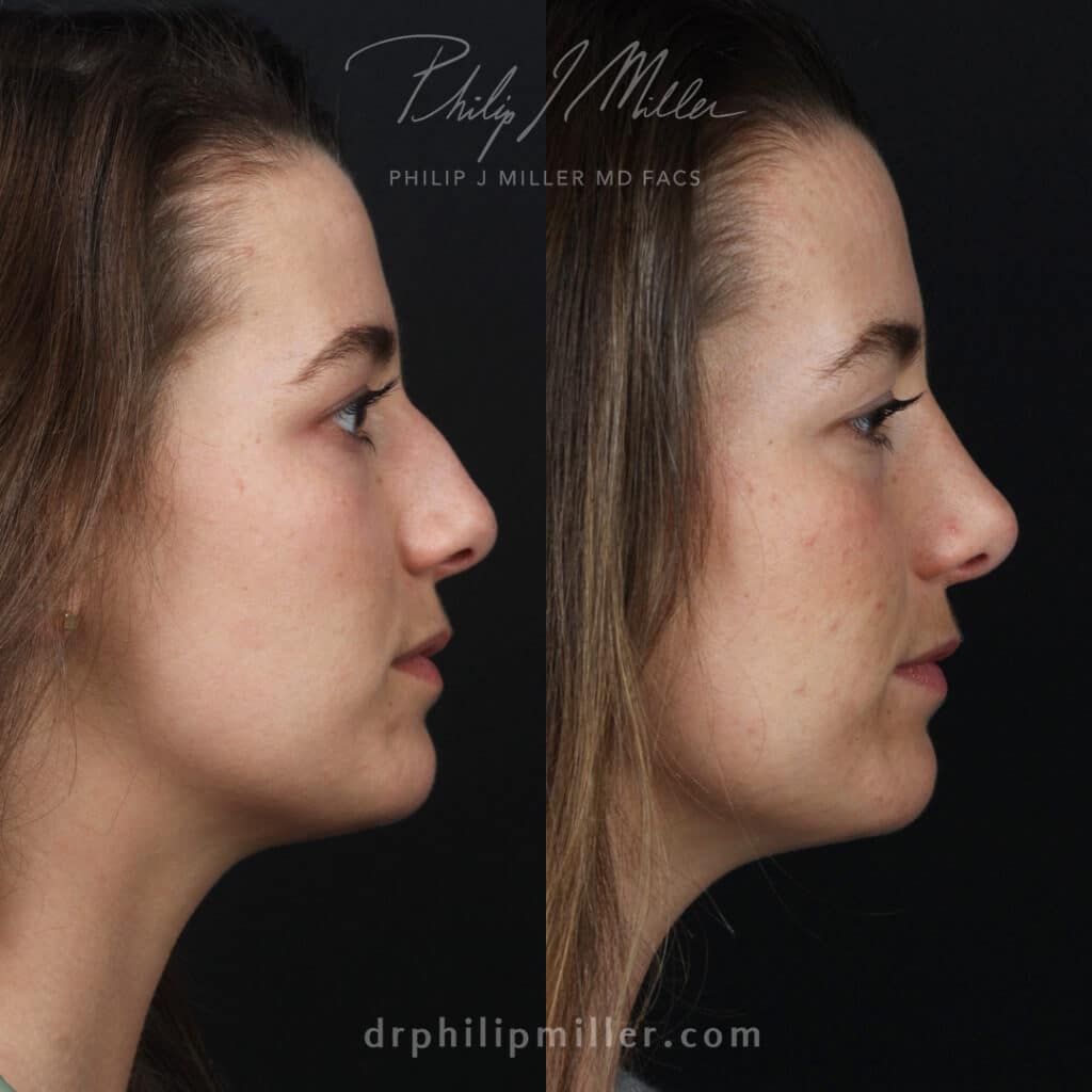 Rhinoplasty results after 9 months to remove dorsal hump and lift the nasal tip by Dr. Miller.