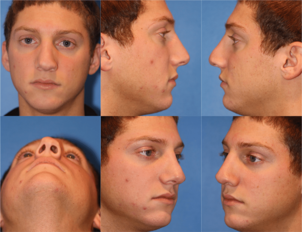 revision rhinoplasty patient before the procedure