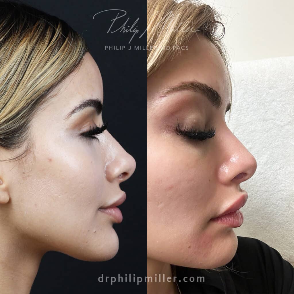 Rhinoplasty to smooth the nasal bridge and enhance the nasal tip by Dr. Miller.
