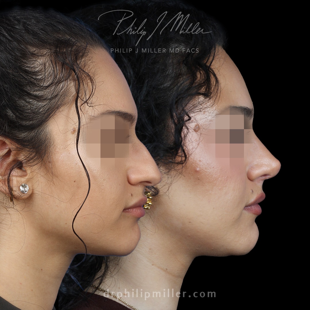 Rhinoplasty to reduce the nasal hump and lift the tip by Dr. Miller.