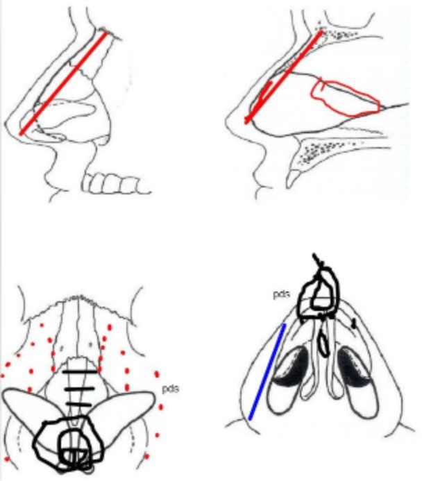 proposed changes to nose structure