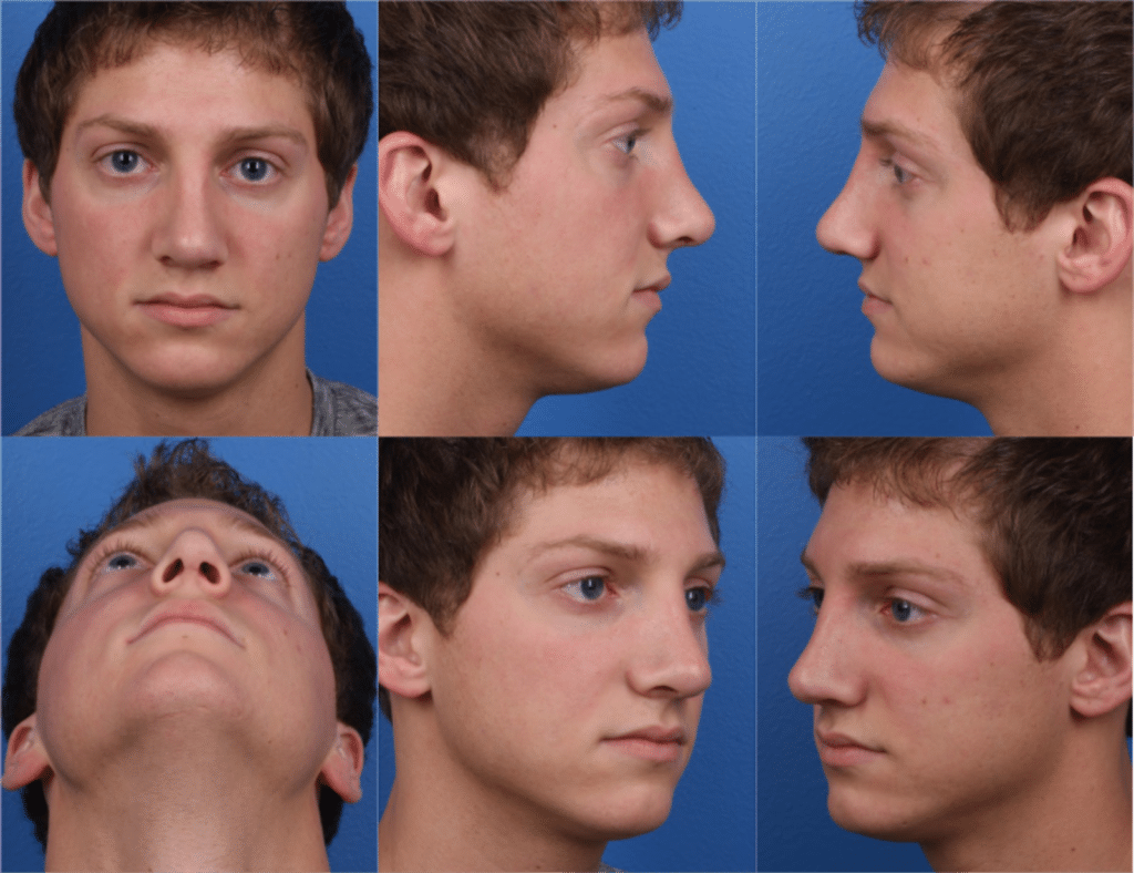 revision rhinoplasty patient after