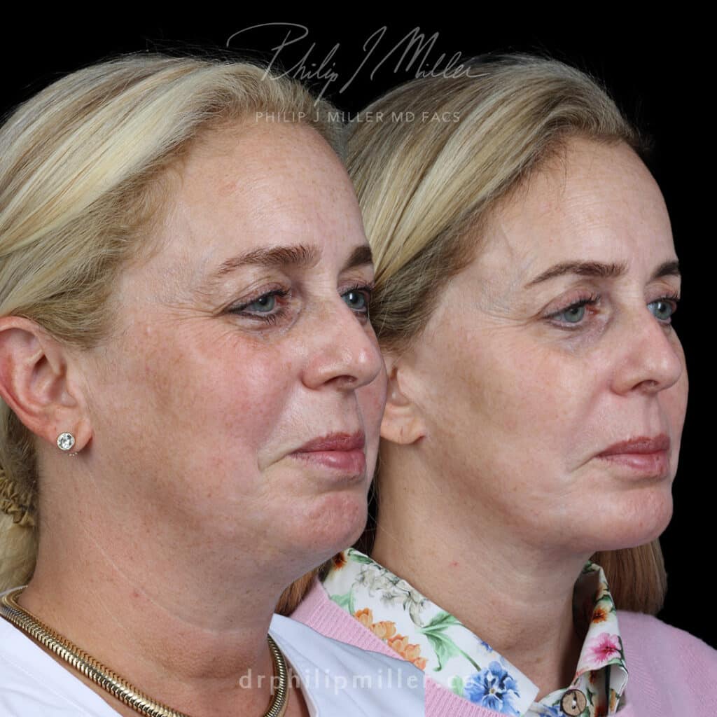 Facelift to refine the jawline and enhance the midface by Dr. Miller.