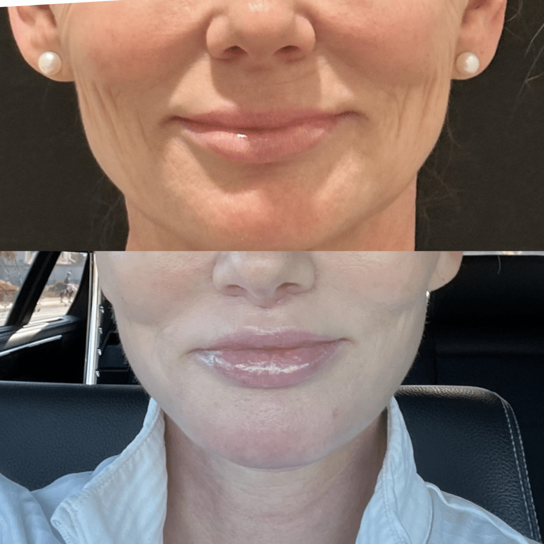 Lip lift to enhance the lips by Dr. Miller.