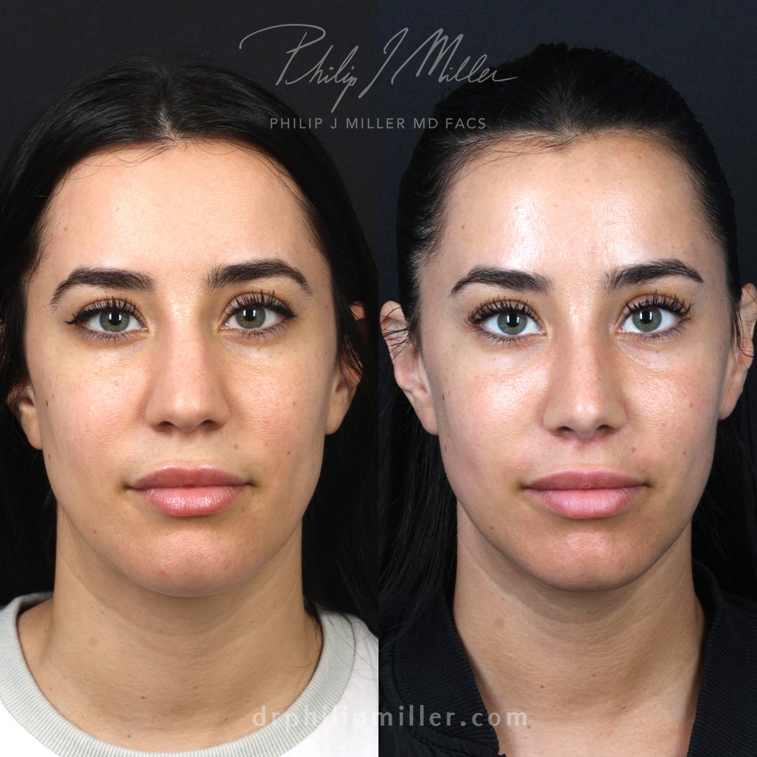 Lip lift and rhinoplasty by Dr. Miller.