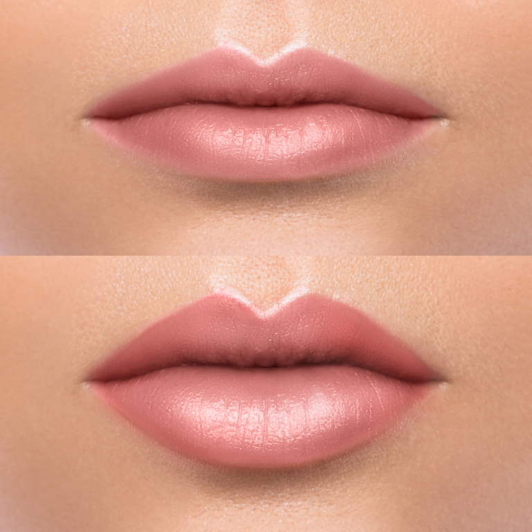 lip lift before and after (not an actual patient)