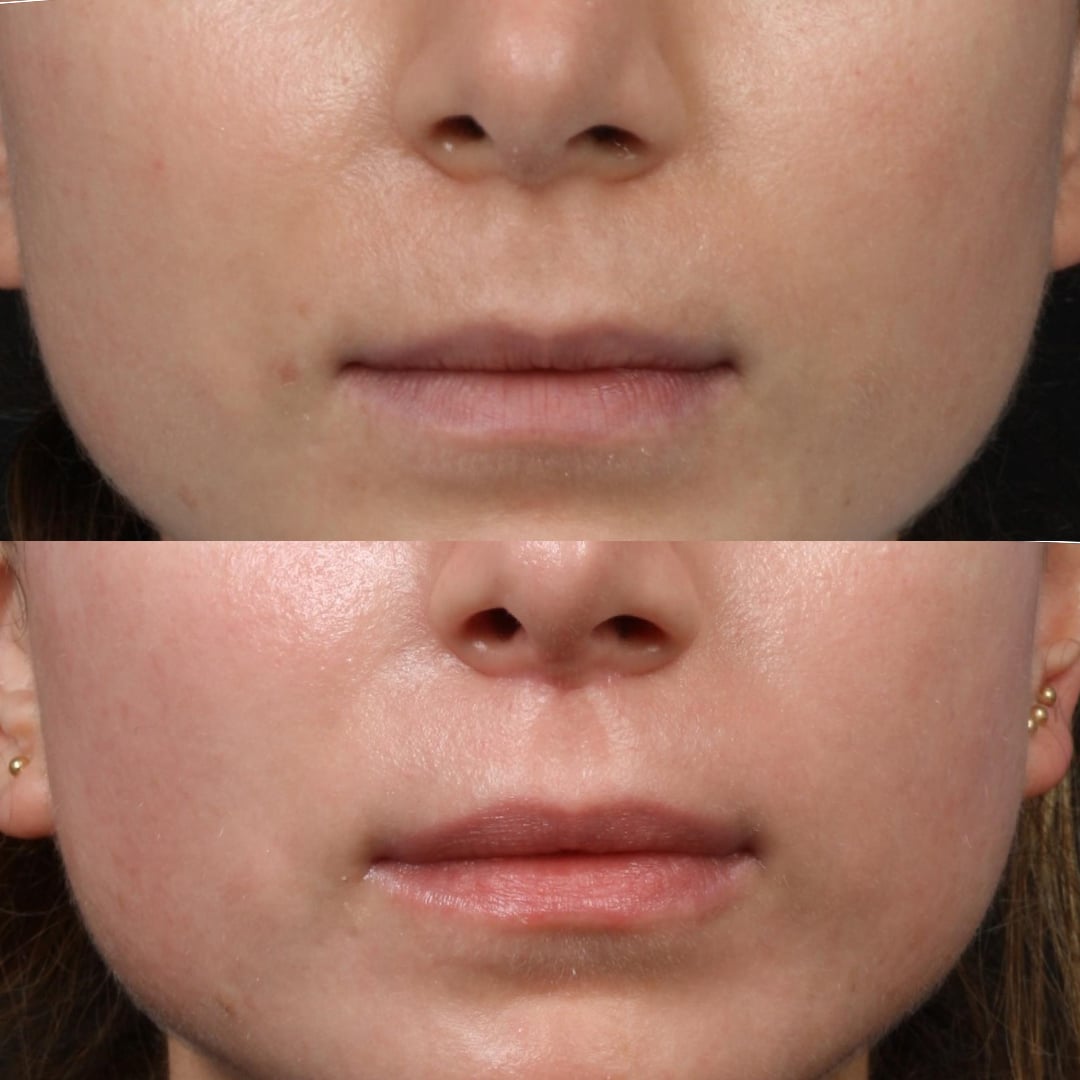 Lip lift to enhance the upper lip's fullness by Dr. Miller.