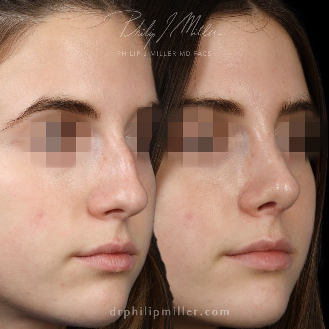 Microrhinoplasty to remove dorsal hump and lift the nasal tip by Dr. Miller.
