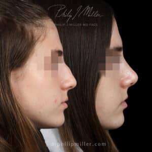 Microrhinoplasty to remove dorsal hump and lift the nasal tip by Dr. Miller new york city