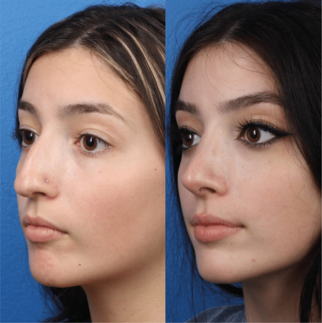 Case Study Illustrated by Rhinoplasty Before and After photo