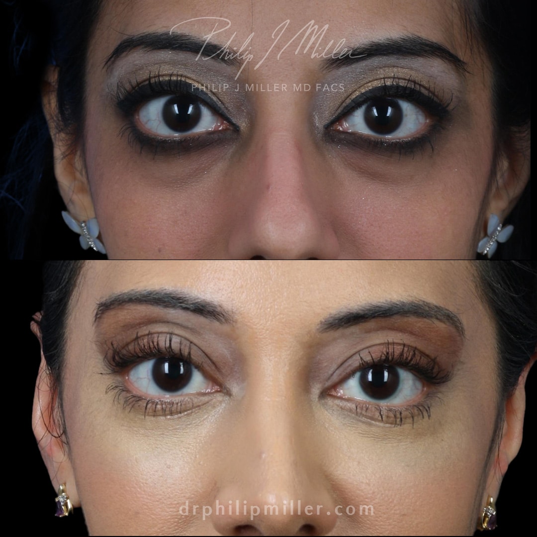 Lower blepharoplasty to rejuvenate the under-eyes by Dr. Miller.
