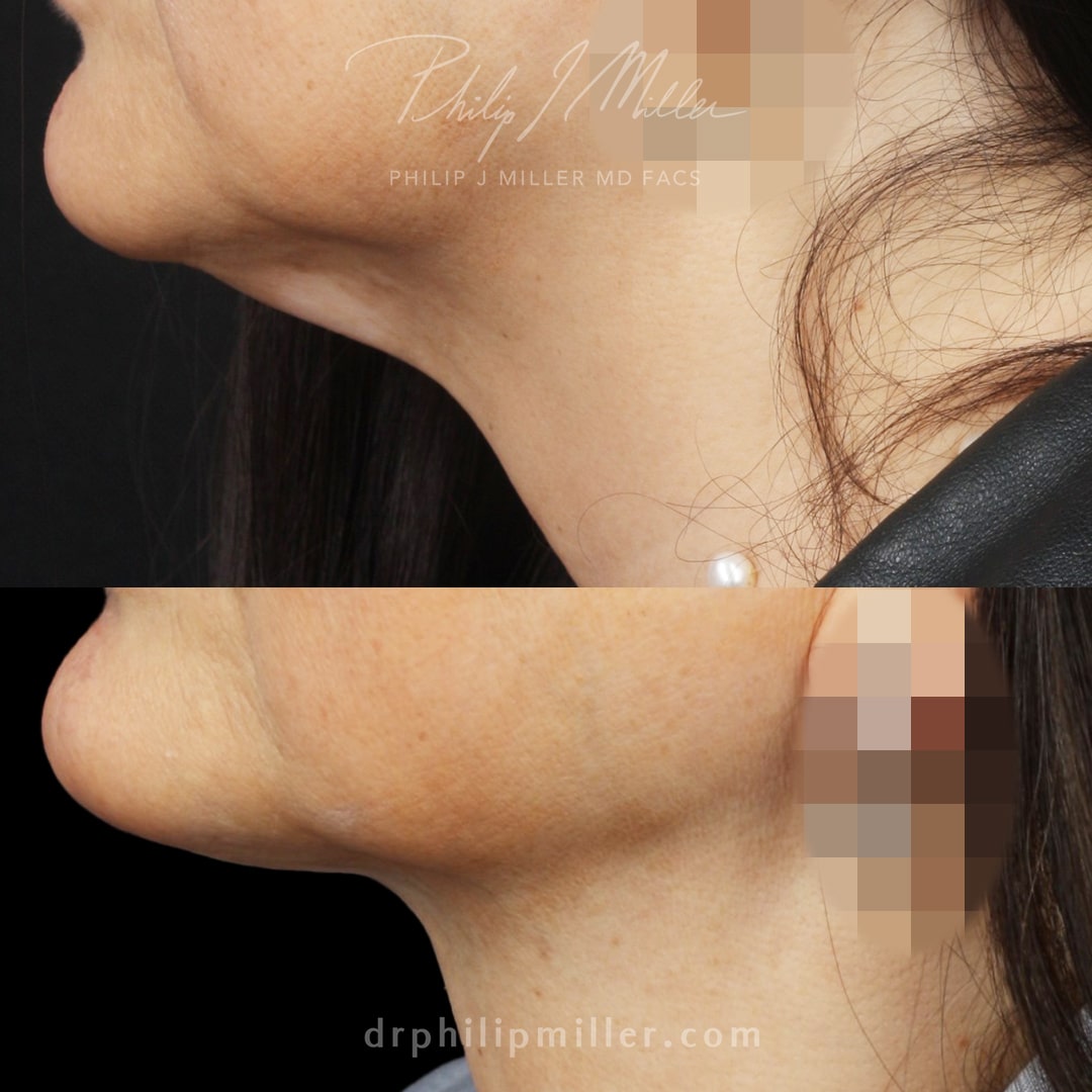 MyEllevate to tighten the jawline and neck by Dr. Miller.