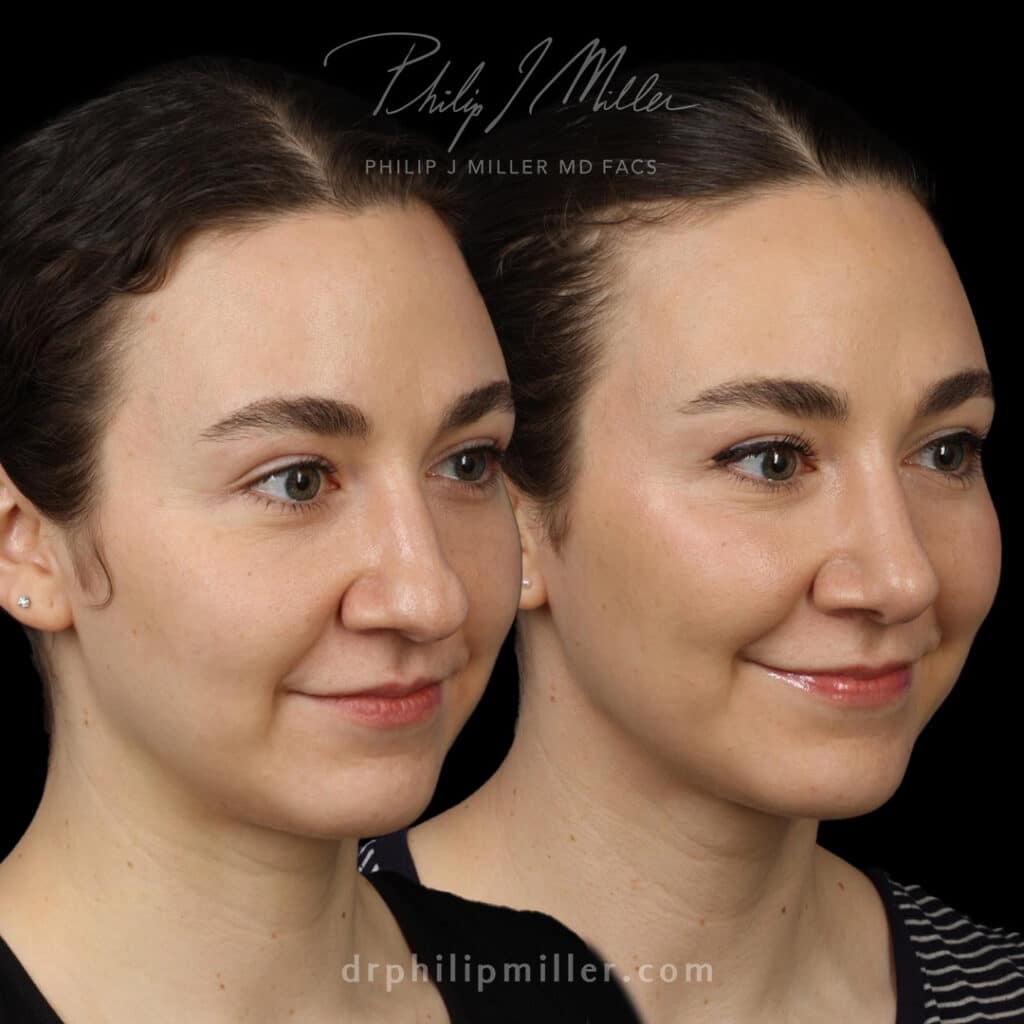 Tip plasty for a more refined nasal profile by Dr. Miller.