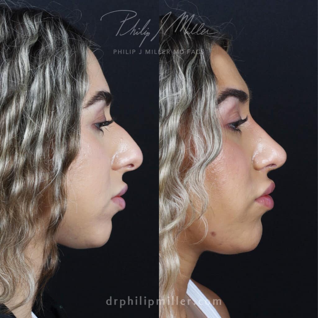 Rhinoplasty to reduce the nasal hump and lift the tip by Dr. Miller in NYC