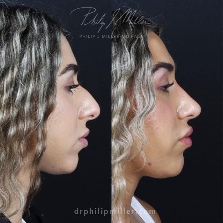 Rhinoplasty to reduce the nasal hump and lift the tip by Dr. Miller in NYC