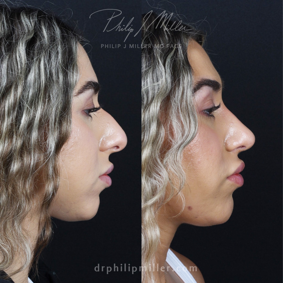 Rhinoplasty to reduce the nasal hump and lift the tip by Dr. Miller in NYC