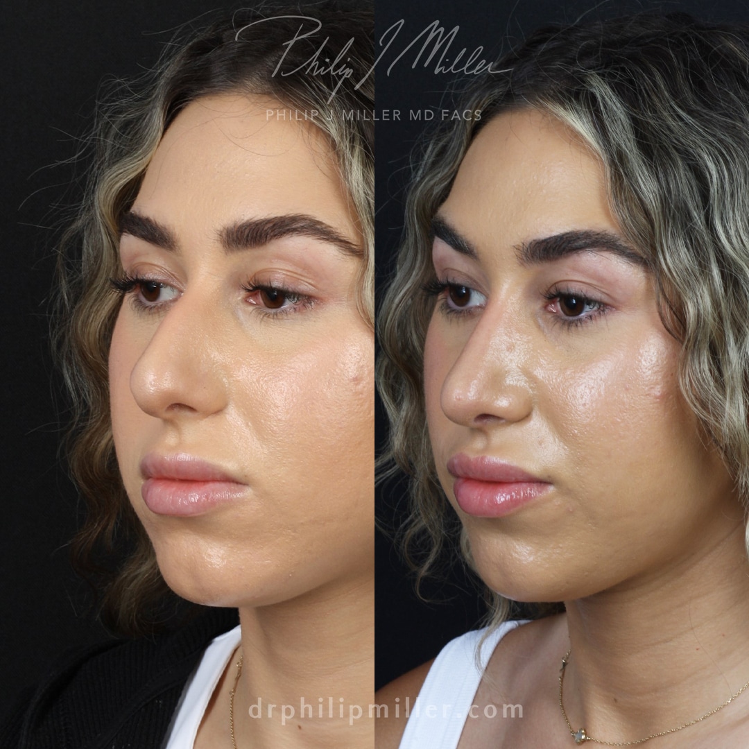 Rhinoplasty to reduce the nasal hump and lift the tip by Dr. Miller in NYC