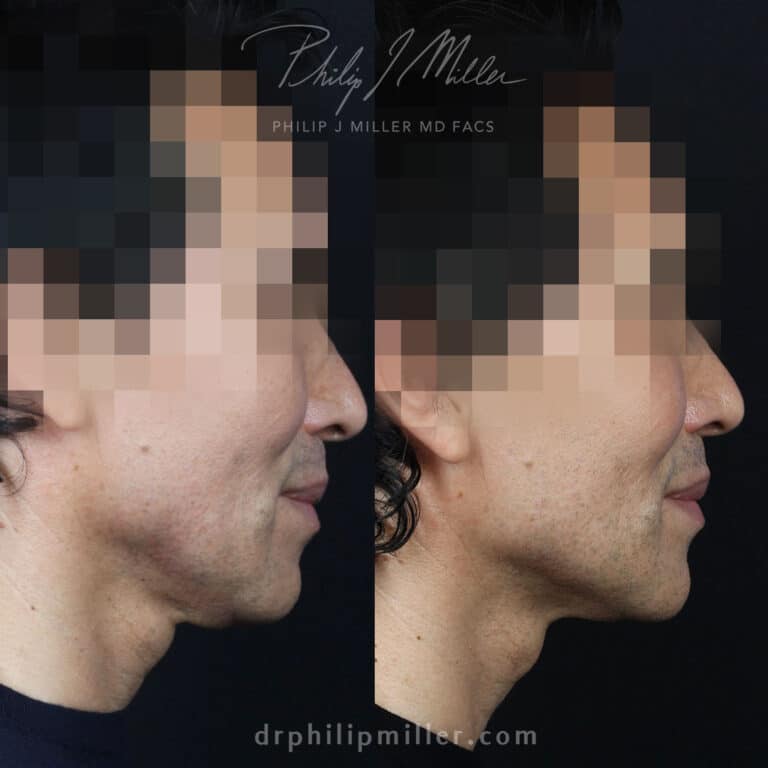 Facelift to lift and tighten the skin around the face and neck by Dr. Miller.