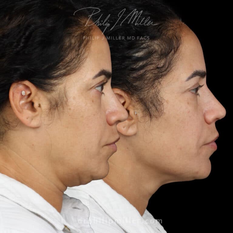 Combined facelift and neck lift to lift and tighten the skin around the face and neck, unveiling a rejuvenated and naturally youthful appearance by Dr. Miller in NYC