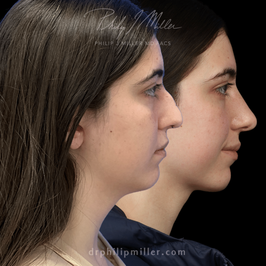 Rhinoplasty results to remove dorsal hump and lift the nasal tip, and Neck Lift to tighten jawline by Dr. Miller.