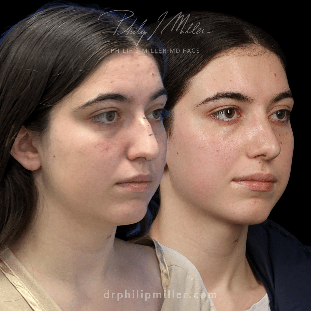 Rhinoplasty results to remove dorsal hump and lift the nasal tip, and Neck Lift to tighten jawline by Dr. Miller.