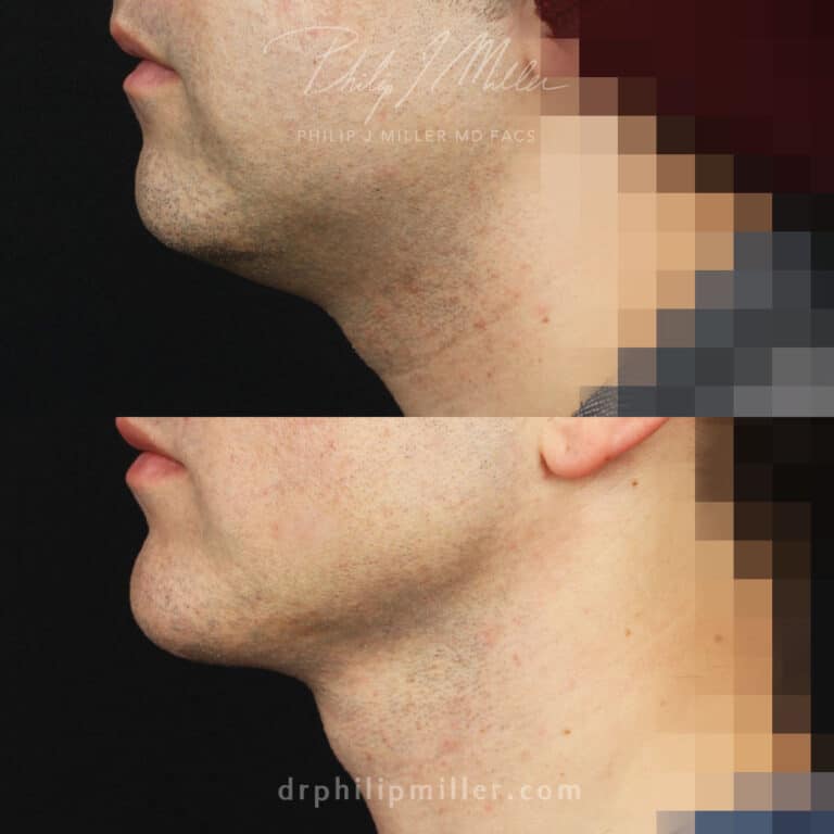 Necklift and chin implant to lift and tighten the skin around the face and neck by Dr. Miller.